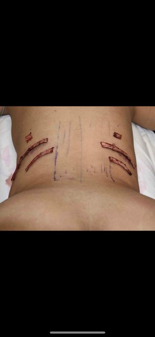 Watch my https://t.co/g8LffgGrJ3 for more information on my #ribRemoval experience Plastic positive #ribremoval<a href="/tag/doll"class="tags"><span>#doll</span></a><a href="/tag/dedication"class="tags"><span>#dedication</span></a><a href="/tag/bimbo"class="tags"><span>#bimbo</span></a><a href="/tag/plasticsurgery"class="tags"><span>#plasticsurgery</span></a><a href="/tag/rib"class="tags"><span>#rib</span></a>