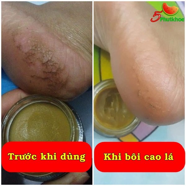 5phutkhoe's tweet photo. Dùng cho da á sừng, da khô, nứt nẻ, vết thương hở, nhanh  liền sẹo.
Dùng cho người bị trĩ nội, trĩ ngoại, trĩ hỗn hợp.
Xem sản phẩm miễn phí 👇
https://t.co/RdY2Sja343
--
#á_sừng #da_khô #khô_da #da_nứt_nẻ #bong_tróc #vết_thương_hở #liền_sẹo #khoda #nutne https://t.co/9PNcTVgEhO