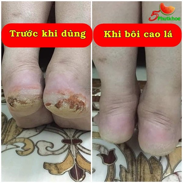 5phutkhoe's tweet photo. Dùng cho da á sừng, da khô, nứt nẻ, vết thương hở, nhanh  liền sẹo.
Dùng cho người bị trĩ nội, trĩ ngoại, trĩ hỗn hợp.
Xem sản phẩm miễn phí 👇
https://t.co/RdY2Sja343
--
#á_sừng #da_khô #khô_da #da_nứt_nẻ #bong_tróc #vết_thương_hở #liền_sẹo #khoda #nutne https://t.co/9PNcTVgEhO