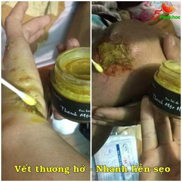 5phutkhoe's tweet photo. Dùng cho da á sừng, da khô, nứt nẻ, vết thương hở, nhanh  liền sẹo.
Dùng cho người bị trĩ nội, trĩ ngoại, trĩ hỗn hợp.
Xem sản phẩm miễn phí 👇
https://t.co/RdY2Sja343
--
#á_sừng #da_khô #khô_da #da_nứt_nẻ #bong_tróc #vết_thương_hở #liền_sẹo #khoda #nutne https://t.co/9PNcTVgEhO