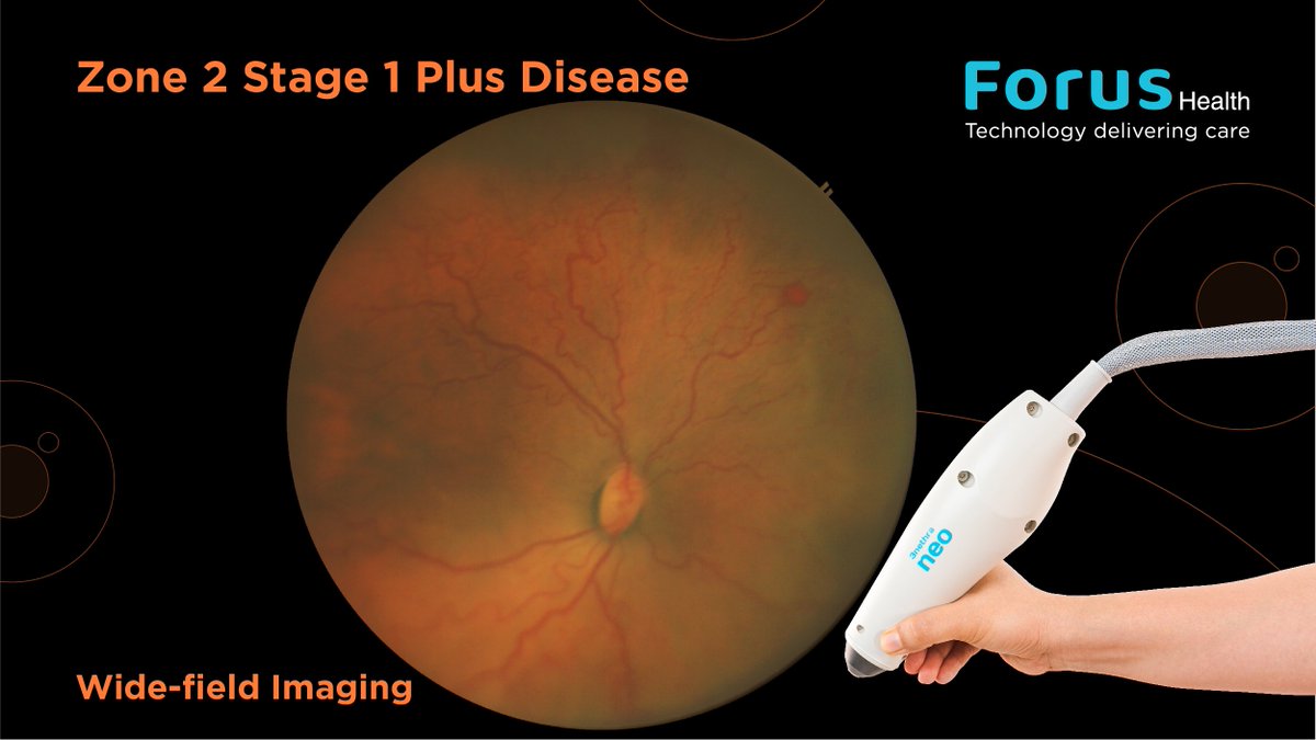 forus_health's tweet photo. The detection of #plusdisease is a critical step in identifying severe cases of #RetinopathyofPrematurity (#ROP) — requiring immediate treatment. #Widefieldimaging and photo documentation can help in early detection and effective disease management. https://t.co/LVSgnMmyCr