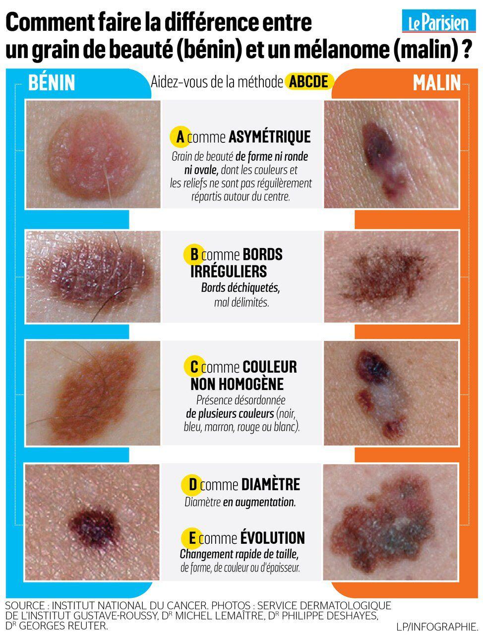 Le Parisien on Twitter faire la différence entre un grain de beauté (bénin) et un