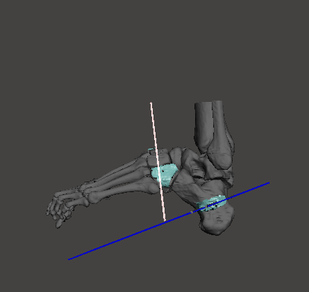 3d_maranon's tweet photo. Surgical guides designed for a cave foot surgery from the Trauma Service of the Hospital Gregorio Marañón. Giving the surgeon the option to plan where the osteotomies would take place beforehand.
Fablab team: @rupermac @calvoharo_ja @diegotrap @AbyAmselem @kn_ord https://t.co/vmbsIFty7f