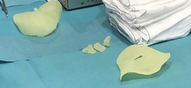 3d_maranon's tweet photo. Surgical guides designed for a cave foot surgery from the Trauma Service of the Hospital Gregorio Marañón. Giving the surgeon the option to plan where the osteotomies would take place beforehand.
Fablab team: @rupermac @calvoharo_ja @diegotrap @AbyAmselem @kn_ord https://t.co/vmbsIFty7f