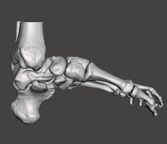 3d_maranon's tweet photo. Surgical guides designed for a cave foot surgery from the Trauma Service of the Hospital Gregorio Marañón. Giving the surgeon the option to plan where the osteotomies would take place beforehand.
Fablab team: @rupermac @calvoharo_ja @diegotrap @AbyAmselem @kn_ord https://t.co/vmbsIFty7f