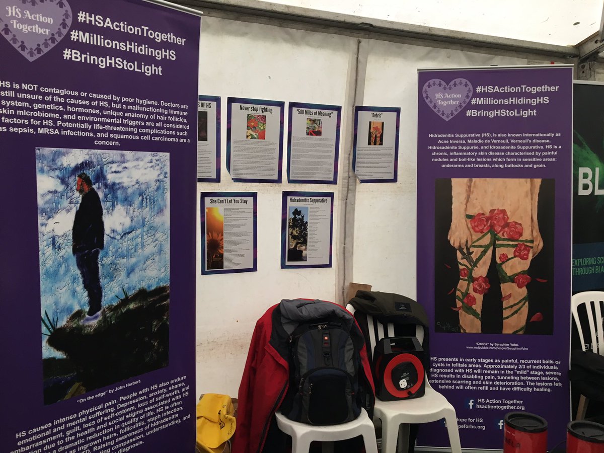 MAParnellHS's tweet photo. Thanks @welcometrust fellow @AnitaShervingt1 hosting the #HSMillillionsHiding exhibit, @Jackson_Gillies #TalkingforHS video &amp; his @AmericanIdol audition chatting @LionelRichie &amp; @katyperry about #HS @blastfestuk @McrCarnival https://t.co/5wbCjUFk5s
#HidradenitisSuppurativa 💜 https://t.co/EcsSMTUOqK