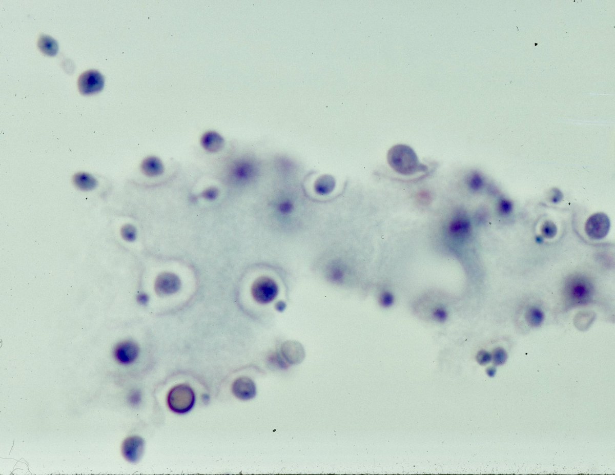 MyCytopathology's tweet image. #CSF #cytology specimen showing variably sized fungal yeast (4-16 μm in diameter) with narrow based (tear drop shaped) budding with thick capsule that form a halo (usually mucin positive). #Cryptococcus Neoformans. Ca be Intercellular and extracellular. @SamKhader #pathology