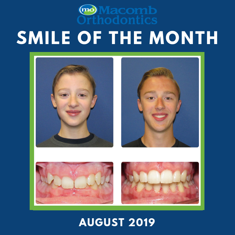 MOSmilz's tweet photo. Congratulations to Alex on being selected for Smile of the Month! You've been a great patient and we're thrilled with your transformation! https://t.co/tpze87F1qu