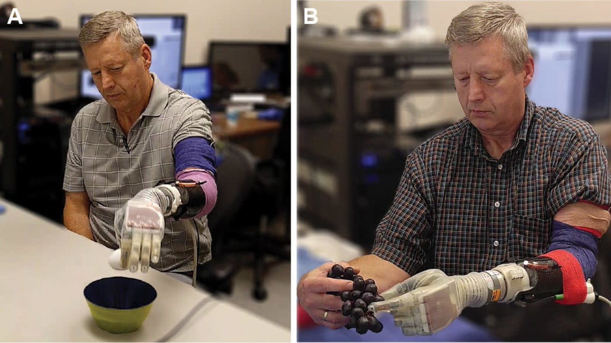 MedicalCenterOP's tweet photo. Scientists at @UUtah say they've created new tech that can return some degree of feeling to #amputees, resulting in sensations that come much closer to mimicking how hands actually feel when compared to any previous attempts: https://t.co/m7y1S8M1pU
#prosthetictech #prosthetics https://t.co/RXlcqvQjPk