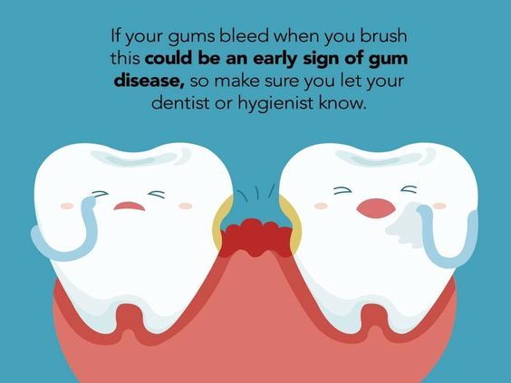 udcwales's tweet photo. *Let us know*

Do your gums bleed?

#UniversityDentalCare https://t.co/0fFlBHYrcn