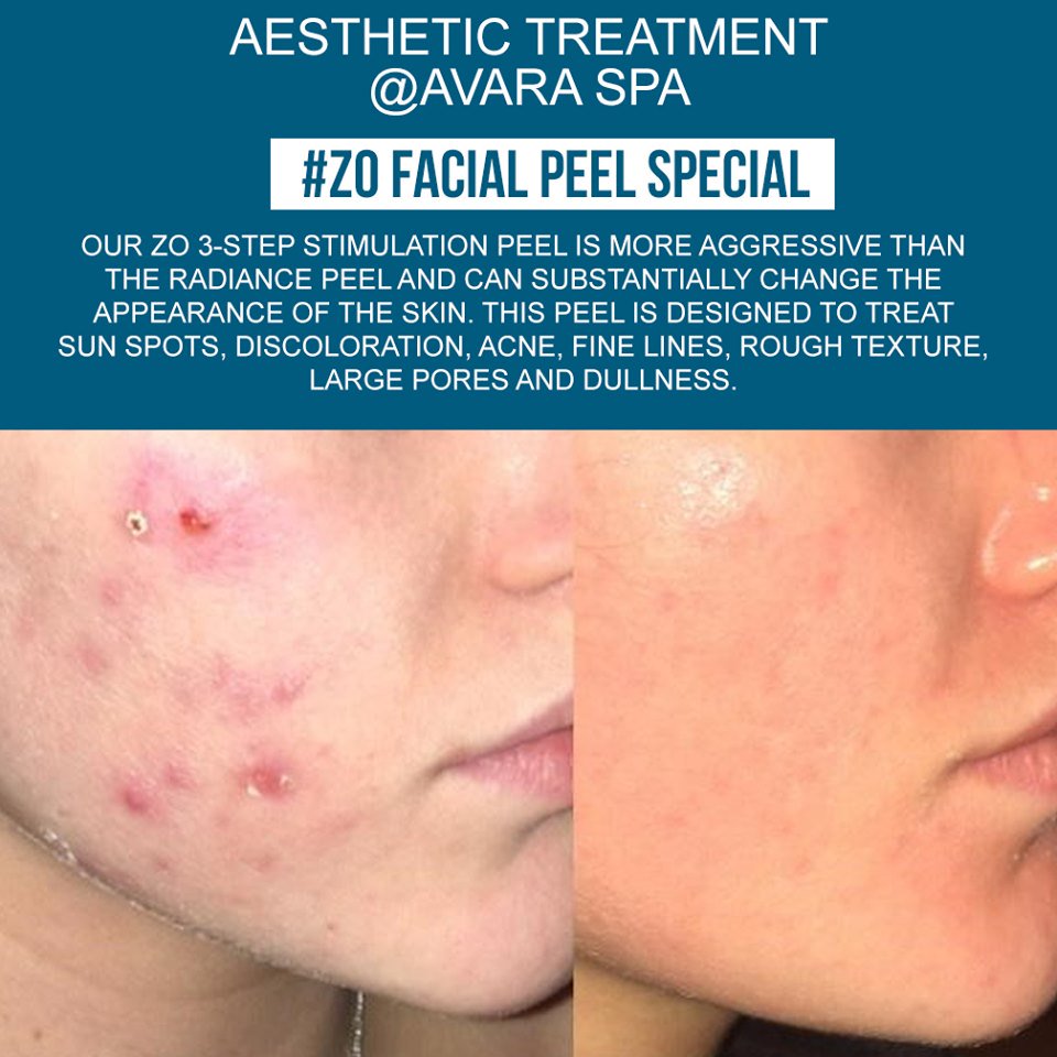 AvaraSpa's tweet photo. Here is our ZO FACIAL PEEL 
An AESTHETIC TREATMENT for your skin @ AVARA SPA. https://t.co/HDYX2NCDth