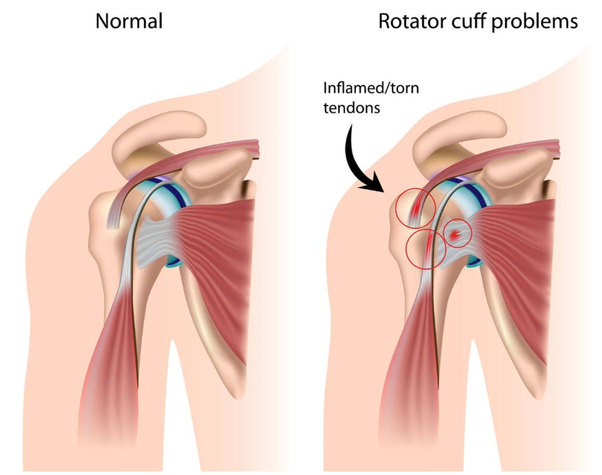 Symptoms of a #RotatorCuffInjury arise from the inflammation that accompanies the structural damage. The most common symptom is pain over the top of the #shoulder and arm. In some patients, the pain can descend down the arm towards the elbow. This pain... medilink.us/4xa1