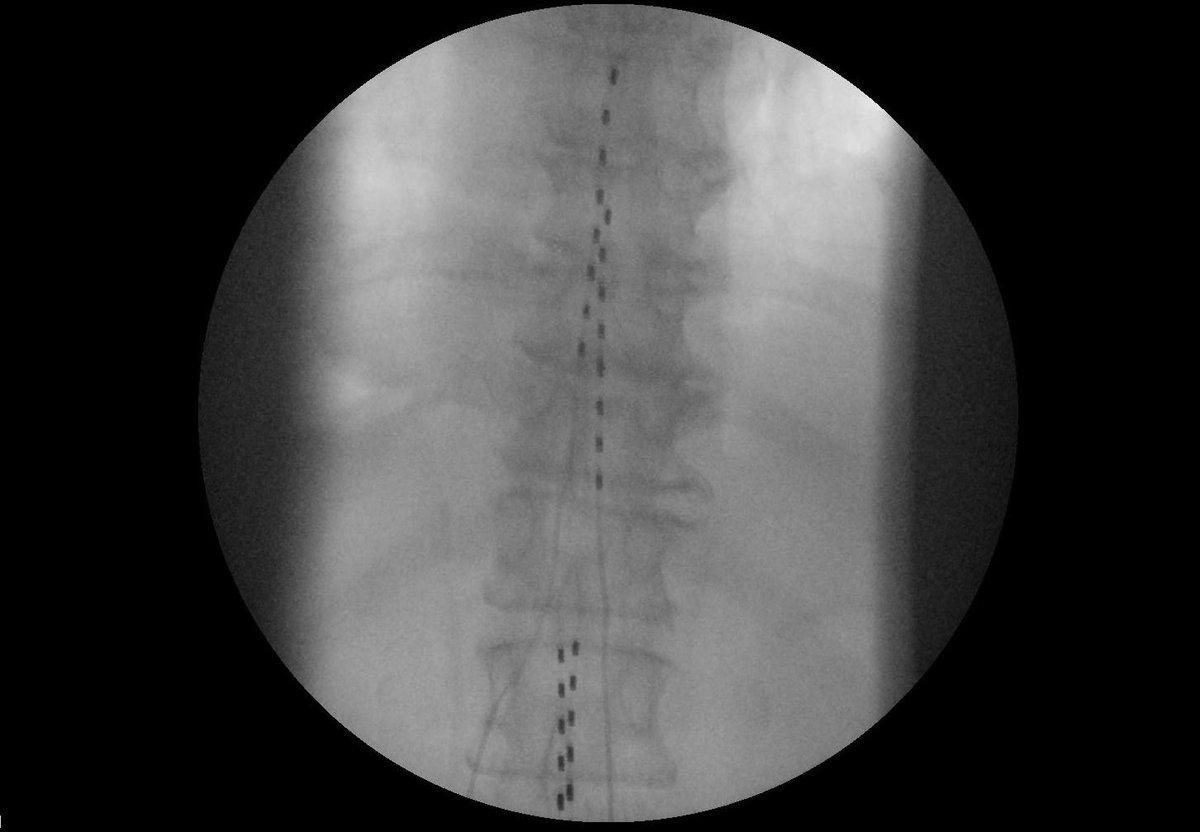 Christopher Paul, MD (@cpaulmd) on Twitter photo First time in 20+ years without chronic pelvic pain. This patient had tried and failed tonic SCS. Pictures like this show how far we've come in #neuromodulation. I'm excited about where we are and where we're going! <a href="/UAMSPain/">UAMS Pain</a> <a href="/uamshealth/">UAMS Health</a> <a href="/NANS_ION/">NANS Official</a> <a href="/ASPN_PainNeuro/">ASPN</a> First time in 20+ years without chronic pelvic pain. This patient had tried and failed tonic SCS. Pictures like this show how far we've come in #neuromodulation. I'm excited about where we are and where we're going! <a href="/UAMSPain/">UAMS Pain</a> <a href="/uamshealth/">UAMS Health</a> <a href="/NANS_ION/">NANS Official</a> <a href="/ASPN_PainNeuro/">ASPN</a>