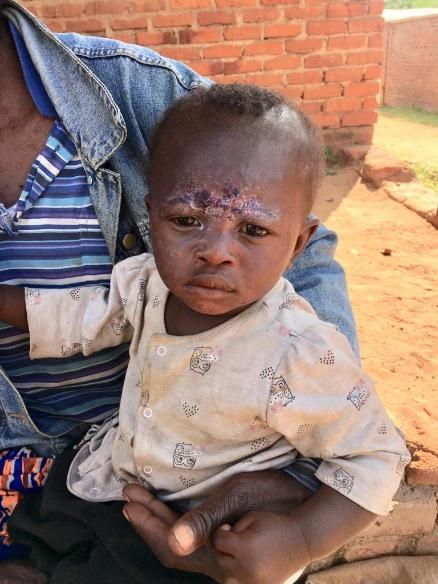 CompassionTea's tweet image. Of Rashes and Burns and Little Ones compassiontea.wordpress.com/2019/08/13/of-…