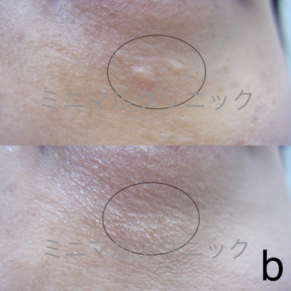 O Xrhsths 汗管腫 かんかんしゅ エクリン汗嚢腫 稗粒腫 はいりゅうしゅ 目の下のブツブツ レーザー治療専門 Sto Twitter 2b 専門的にレーザー治療しています レーザー認定医 公式サイト T Co Y9coxhgk32 汗管腫 かんかんしゅ 稗粒腫 はいりゅう O Xrhsths 汗管腫 かんかんしゅ エクリン汗嚢腫 稗粒腫 はいりゅうしゅ 目の下のブツブツ レーザー治療専門 Sto Twitter 2b 専門的にレーザー治療しています レーザー認定医 公式サイト T Co Y9coxhgk32 汗管腫 かんかんしゅ 稗粒腫 はいりゅう