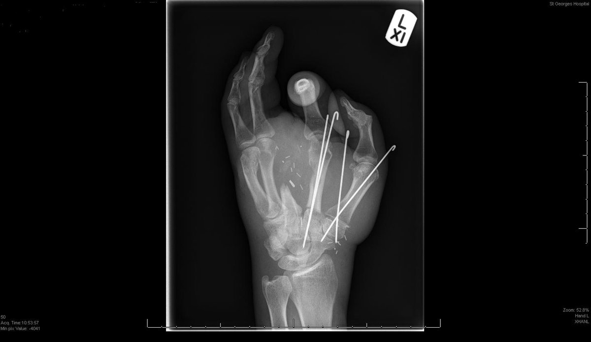 tootingnewsie's tweet photo. Surgeons at #Tooting's @StGeorgesTrust save man’s hand after seventeen hours of surgery. More on our blog: https://t.co/NH6jGgOOQz https://t.co/2RY6vmUGP4