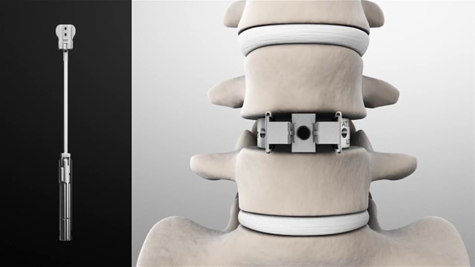 DrSusmitNaskar's tweet photo. ✔️ Artificial #Spine #LumbarDisc Replacement in India
▫️
▫️
✔️ Are you suffering from spinal or any other related pain? Request an appointment with Dr. #SusmitNaskar today. Visit https://t.co/bH9ibCgx1v for appointment.
▫️
▫️
✔️ #SpineLumbarDisc https://t.co/niwkfJqq4j