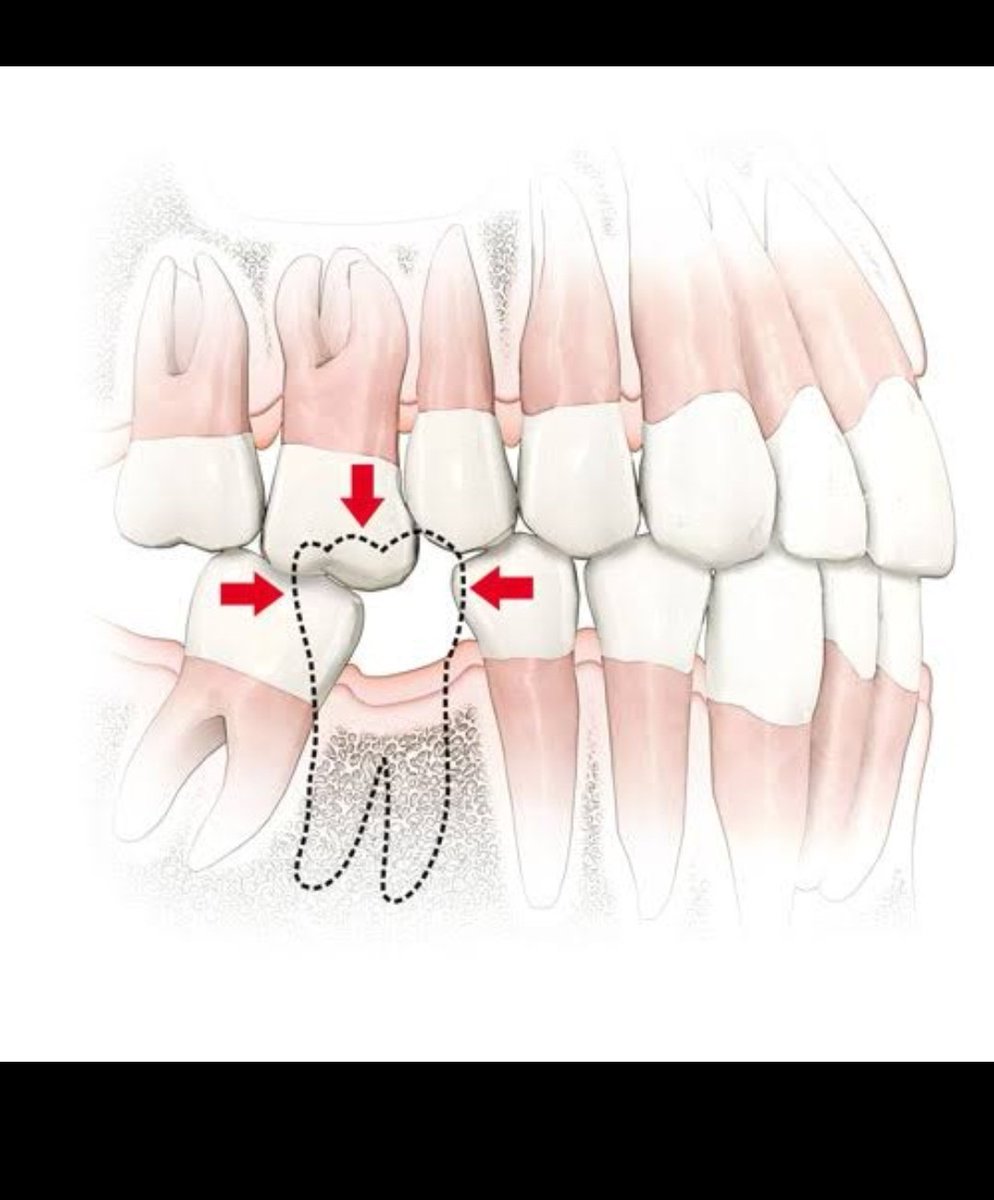 Jadi gigi dalam mulut kita itu dinamis. Ketika tetangganya sudah dicabut, dia kehilangan bahu untuk bersandar.Maka akan terjadi pergeseran gigi. Depan dan belakangnya akan "ambruk" ke area tak bergigi, gigi antagonisnya akan memanjang.