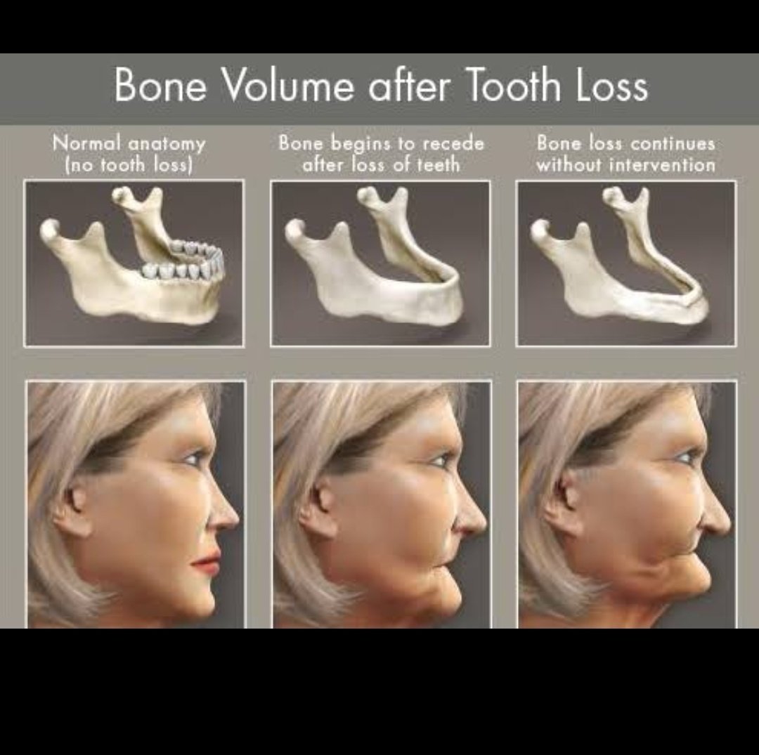 Efek lain dari pencabutan gigi adalah kehilangan volume tulang.Mengecilnya tulang rahang bisa mempengaruhi hubungan sendi rahang yg nanti bisa berefek pada fungsi lain.