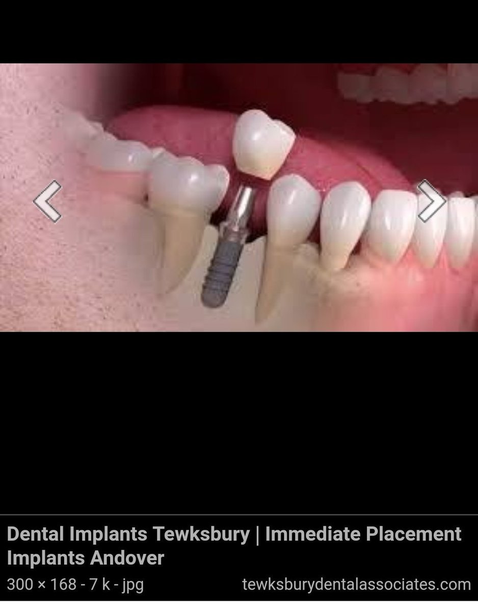 Gigi tiruan cekat misalnya implan. Ini udah mulai trend. Tapi memang harga lumayan tinggi dan tidak semua drg bisa melakukannya karena perlu keahlian khusus.Saya?Nggak bisa!Jd implan itu ada perangkat yg ditanam di dalam tulang, lalu di atasnya akan ditutup mahkota buatan.