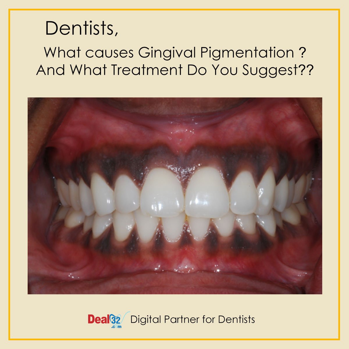 Deal32dotCom's tweet photo. Dentists, What causes Gingival Pigmentation?
And What Treatment Do You Suggest??

#dental #gingival #teeth #gumpigmentation #dentaltreatment #dentist #deal32 #dentistry #dento #bds #mds #fururedentists #instadentist #dentistrysociety #worlddentists https://t.co/w1YhKR9TCd