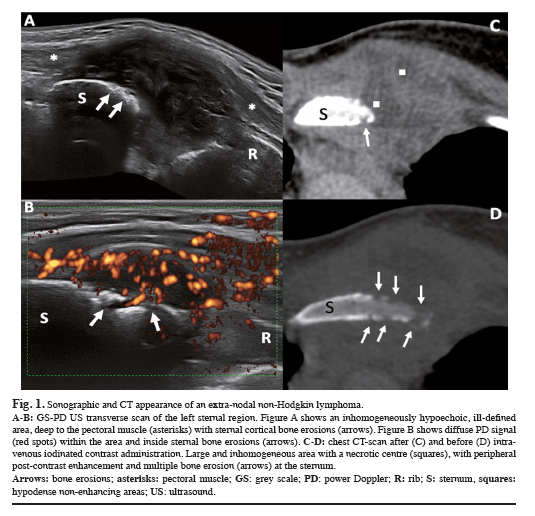 clinexprheum's tweet photo. #JulyAugustIssue: "When #chest #pain is not “just” #Tietze’s syndrome: a case of non-#Hodgkin's #lymphoma" a free to view letter https://t.co/1lBXYst2Ev https://t.co/xXevfUmVRX
