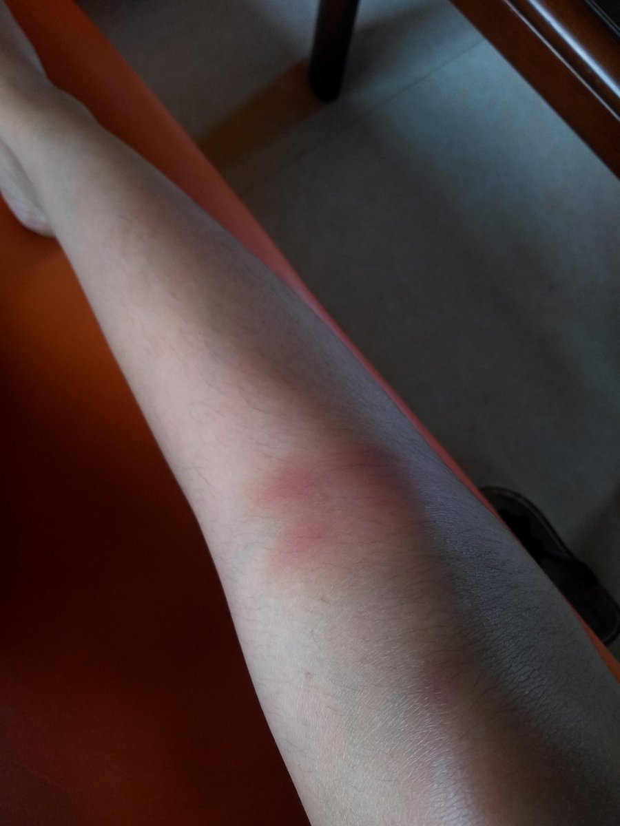 — I got a lot of bruises after the con but it's all worth it Napakasakit ng buong katawan ko aaaaaaaaaaaaaa—