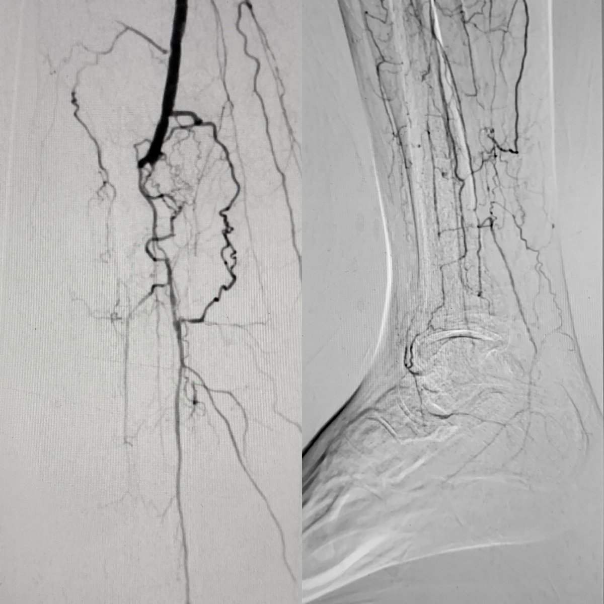 SriniTummala's tweet photo. Importance of limb salvage can’t be emphasized enough. 2 vessel recan/pedal loop reconst. 4 mo f/u &amp; healing continues with good wound care of course. CLI needs a team! You can’t do it alone! @SIRspecialists @SIR_ECS @ACCinTouch @VascularSVS @AMPSymposium @cvcpvd @TCTConference https://t.co/odDKj0dtJ0