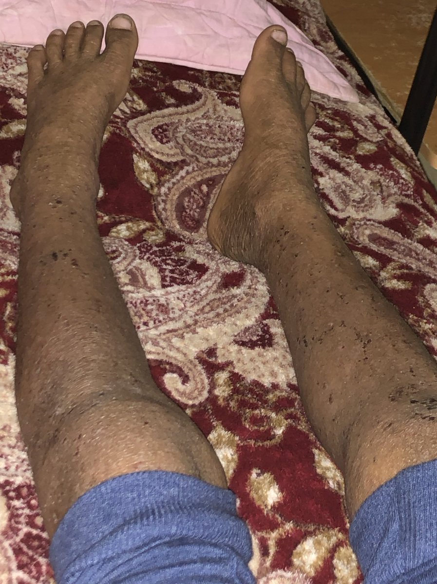 thestrongrayan's tweet photo. #معاناة_ريان_الغامدي يا فعالين الخير ابني ريان الغامدي مريض DOC8 اكزيما وحساسيه ف الدم ومرض نقص المناعه مع الزمان فقد احدى عيناه من ازدياد سوء المرض مصاب فيها له10 سنين طفل صغير جرب معنى ال��لم صحيح اني امه لكن ليس ف يدي حيله ينفطر قلبي ع ابني وهو يتألم كل ثانيه وحالته تزداد سوء . https://t.co/Bn6DSZ3qWu