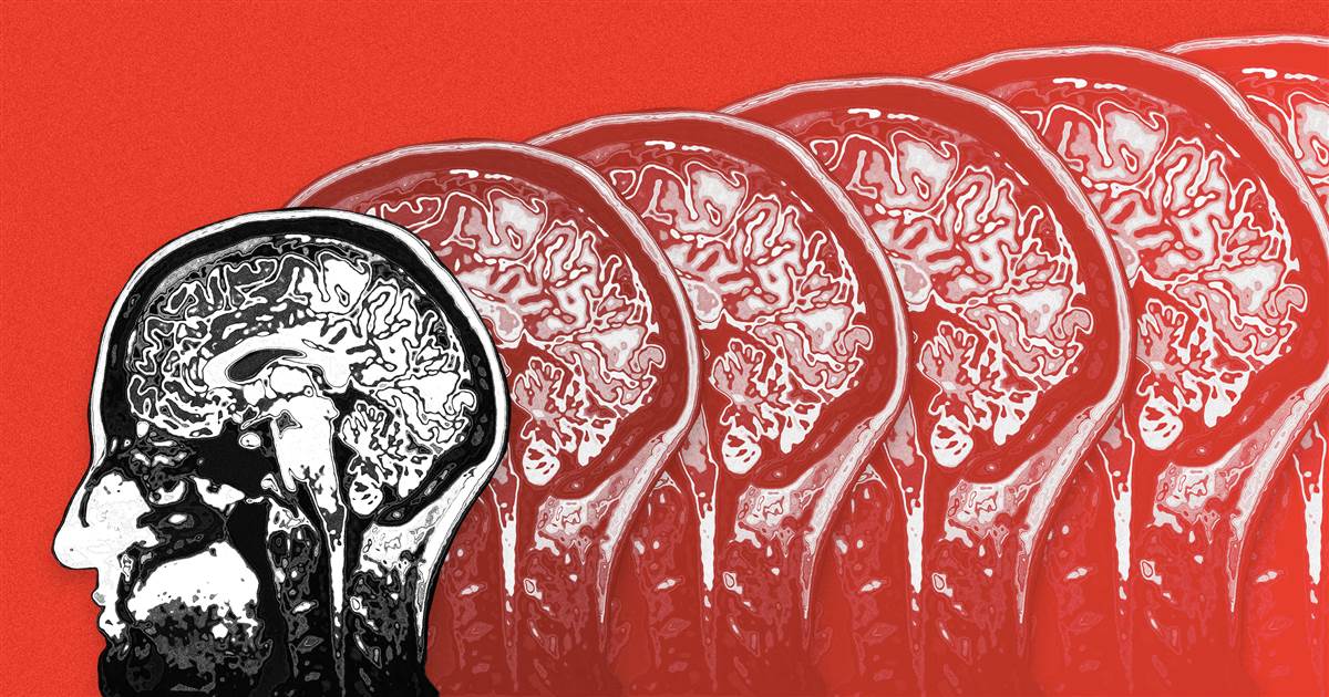 INmuneBio's tweet photo. The focus on #Alzheimers treatment is shifting to #neuroinflamation. According to Professor of Neurology, Rudolph Tanzi, neuroinflammation is killing nerve cells that leads to #dementia. #AlzheimersDisease #Alzheimersresearch #endAlz @NBCNewshttp://ow.ly/rIxN50vJdVu https://t.co/NSsrDqLR2w