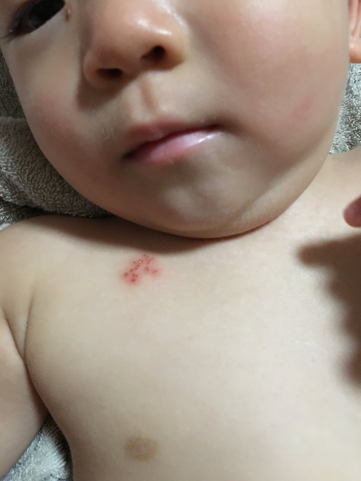 Twitter 上的 星井サキコ De 木曜に水痘の予防接種をした赤ちゃん息子 金曜に胸に特徴的な発疹がでて カポジ水痘様発疹症 単純ヘルペス の既往があるから わーまたヘルペス って焦った よく考えたらきのう水痘接種したからそれだって気づいたけど