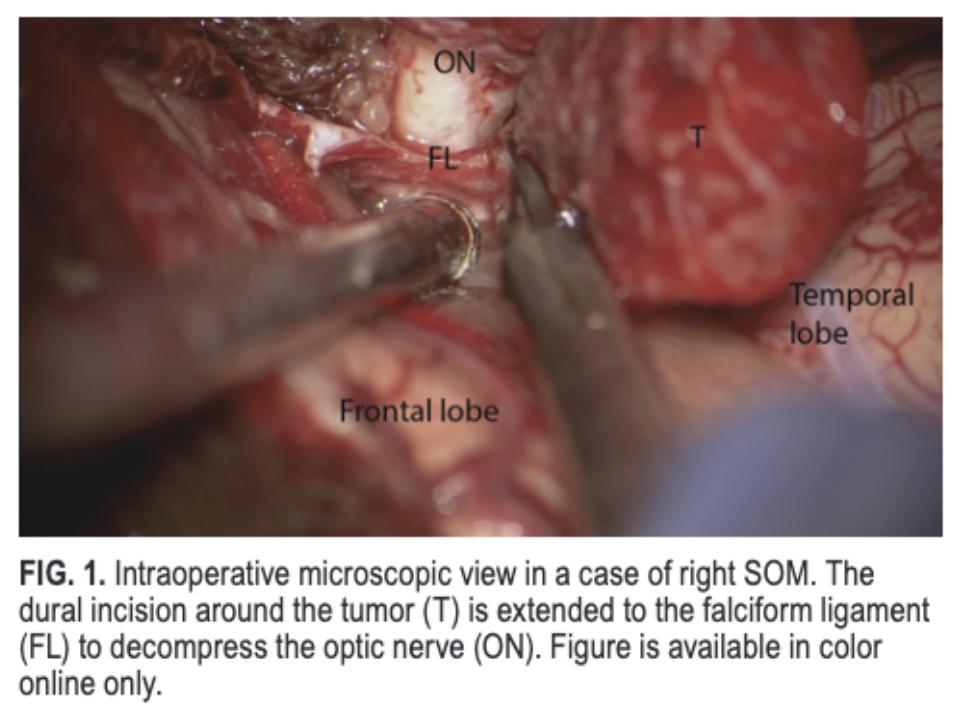 TheJNS's tweet photo. #OnlineFirst: Sphenoorbital meningioma: a unique skull base tumor. Surgical technique and results https://t.co/scMrJdnY85 https://t.co/7aWnvUwOXz