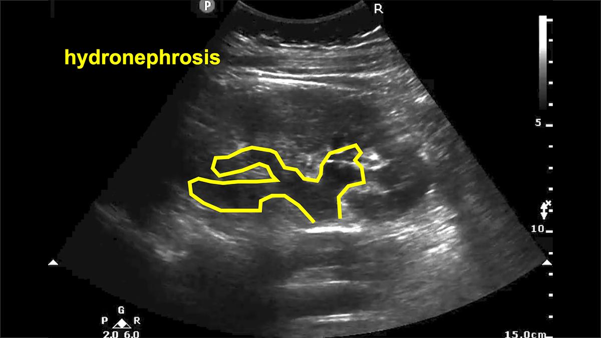 the osteoporotic syndrome detection