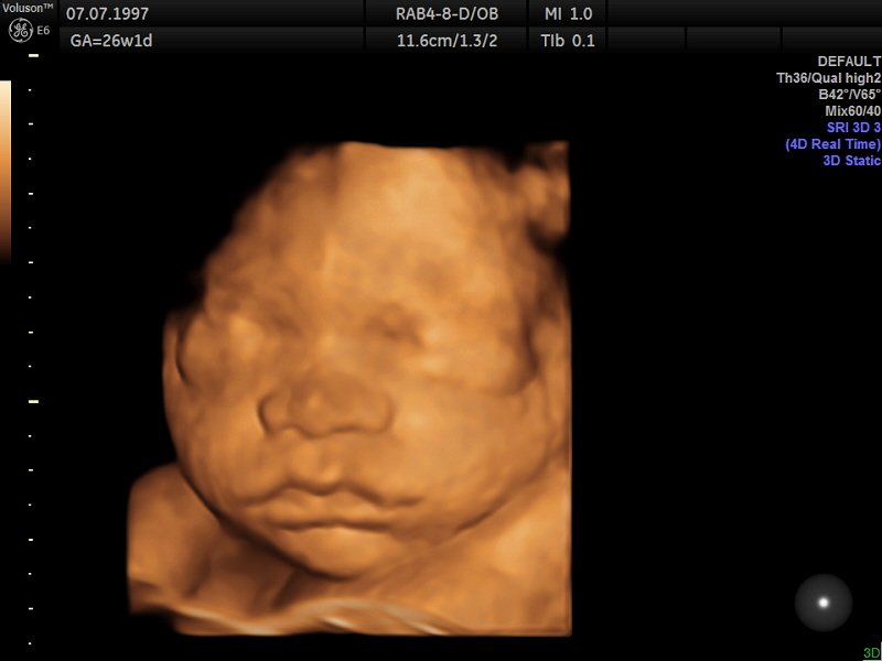 Ultrasound Direct West Midlands Twitter: "This 4D scan picture was taken at 26 weeks gestation. To choose and book your 4D scan visit https://t.co/i5ukq7GeKv We forward to meeting you soon.
