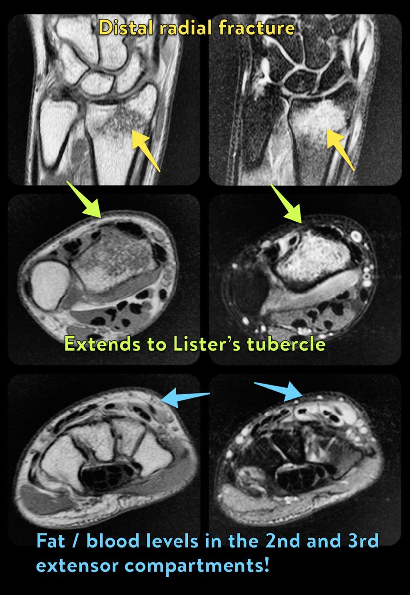 morrisonMSK's tweet photo. Cool fat-blood level in tendon sheath from adjacent fracture!
https://t.co/85sbGTKYxa https://t.co/yvhQswN6ht