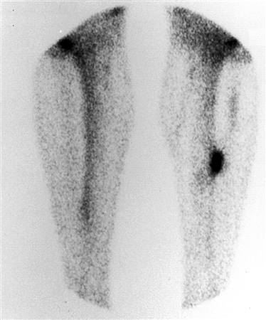 orthobullets's tweet photo. Post-traumatic tibiofibular synostosis may occur following a high ankle sprain where the interosseous membrane was disrupted. The heterotopic ossification usually develops within 6 to 12 months. Learn more on today's podcast about high ankle sprains: https://t.co/Yr8bDH0KRs https://t.co/rcTopAqxKb