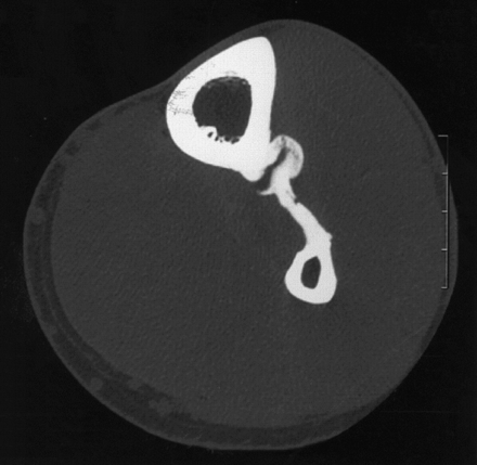 orthobullets's tweet photo. Post-traumatic tibiofibular synostosis may occur following a high ankle sprain where the interosseous membrane was disrupted. The heterotopic ossification usually develops within 6 to 12 months. Learn more on today's podcast about high ankle sprains: https://t.co/Yr8bDH0KRs https://t.co/rcTopAqxKb