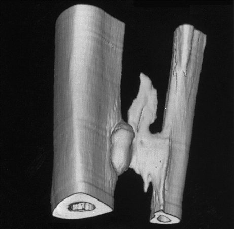 orthobullets's tweet photo. Post-traumatic tibiofibular synostosis may occur following a high ankle sprain where the interosseous membrane was disrupted. The heterotopic ossification usually develops within 6 to 12 months. Learn more on today's podcast about high ankle sprains: https://t.co/Yr8bDH0KRs https://t.co/rcTopAqxKb
