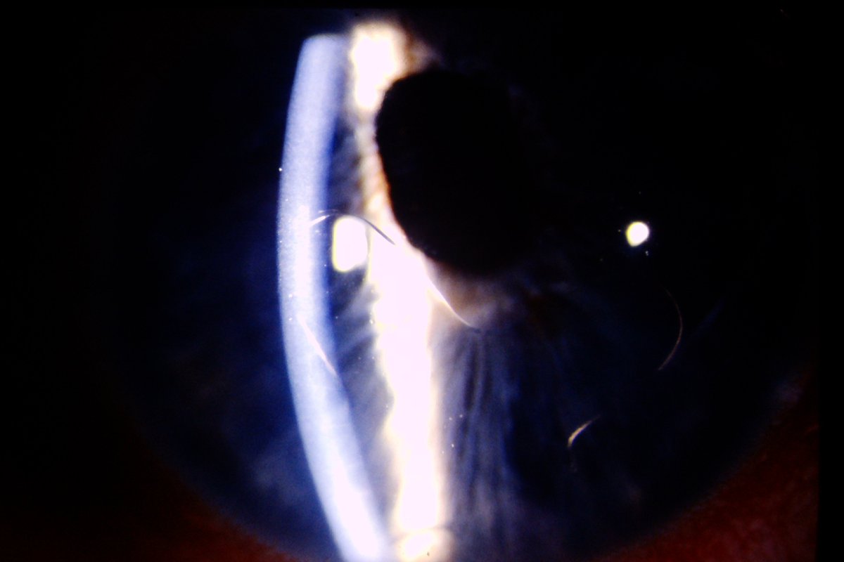 EyeCornea's tweet photo. Copeland iris-pupil fixated IOL dislocated into the anterior chamber with corneal endothelium touch. Read the history: https://t.co/zuyzwiSoqR #IOL #DislocatedIOL #CopelandIOL https://t.co/FrjMPm3yIm