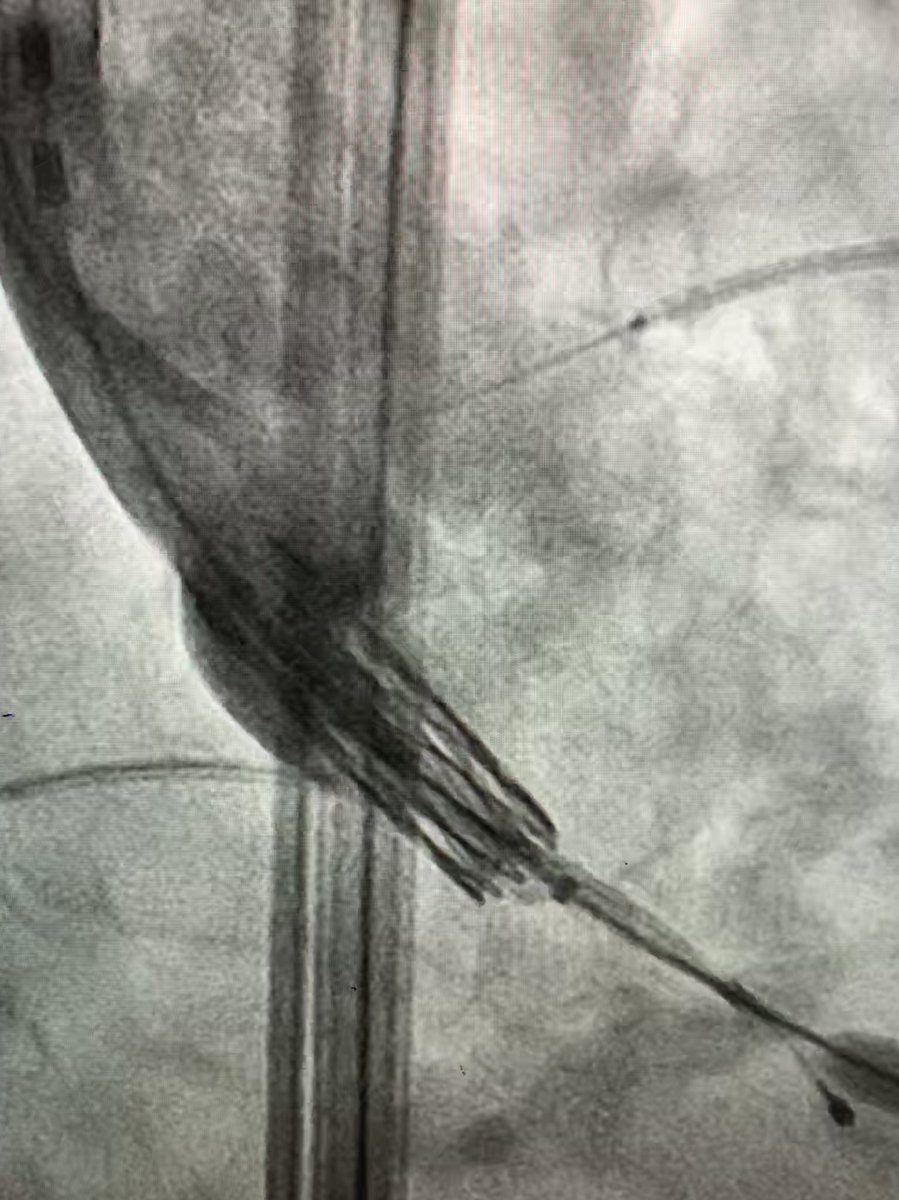 GilbertTangMD's tweet photo. Follow-up on #lowrisk #TAVR patient with high risk features. 23mm nominal #Sapien3 with LM protection. Bulky leaflet #stringsign at ostium #PCI with 2 DES to create a snorkel. How durable is this?! https://t.co/u93262z99Y