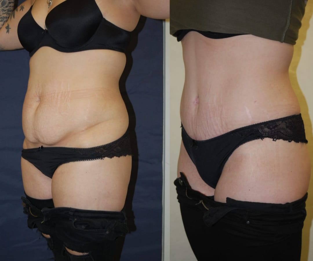 CardiffClinic's tweet photo. Continuing on with results week this lady had abdominoplasty (tummy tuck) with Mr Karoo. #results #plasticsurgeon #cardiff https://t.co/8QD9EPkPjU