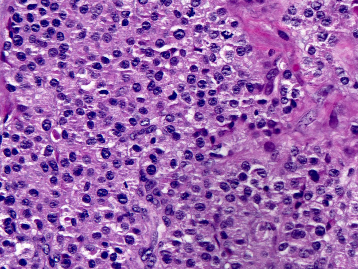 smlungpathguy's tweet photo. O brave and wise Tweeples, would you like to hazard a guess on this lung nodule? Extra points to those who get it on H&amp;E alone. I will post one #ihcpath clue every 12 hours. 

#pathology #pulmpath @natasharekhtman @JenniferBoland7 @Sinchita_Roy @lara_pijuan @SansanoValero https://t.co/Z6BiV3LA8X