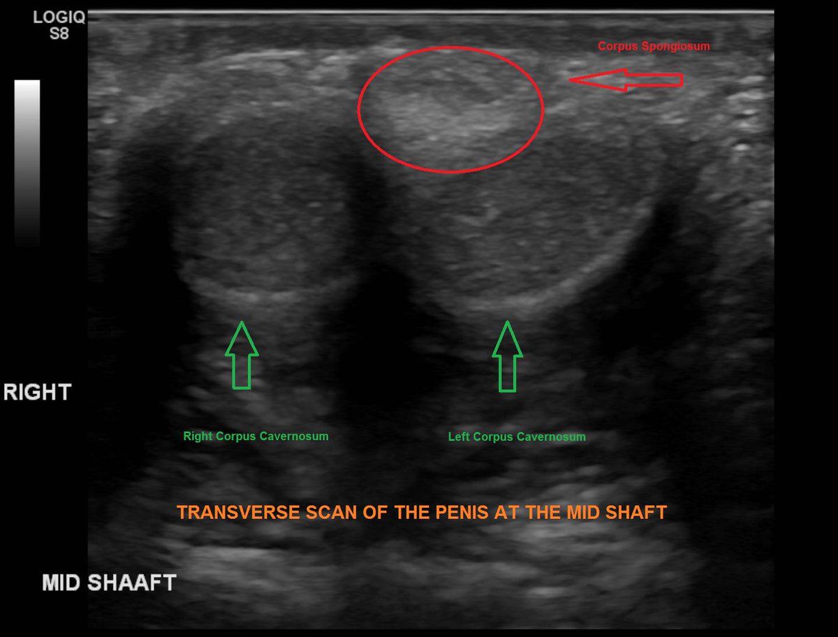 Nsh Radiology On Twitter Penile Color Doppler Ultrasound An Ignored Skill By Many Radiologists Now Can Be Done At Alnoor Specialist Hospital A Case Of Venogenic Erectiledysfunction Venous Leak Radiology Irad Diagnostic