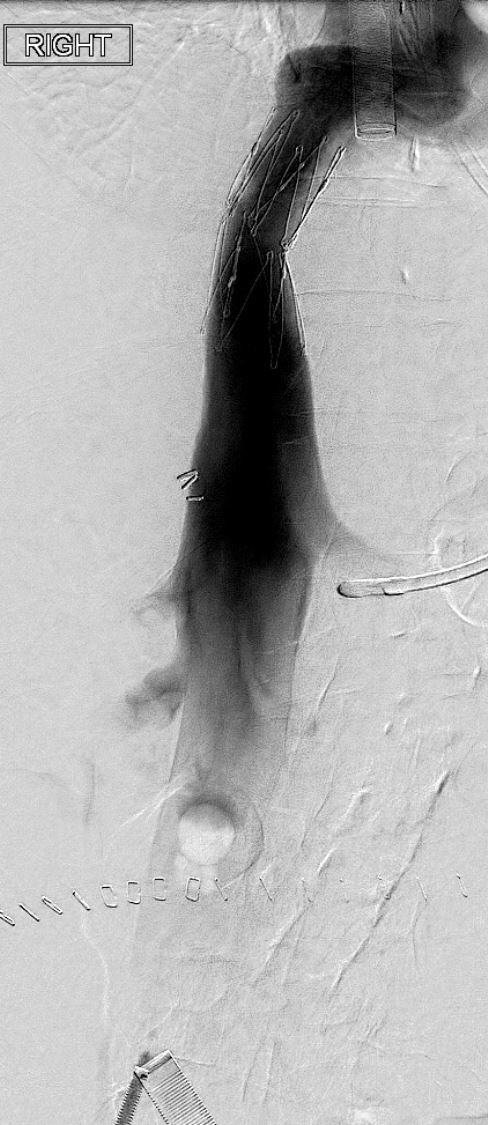 TheRealDoctorOs's tweet photo. In honor of my 2000th follower, time to post a case worthy of 2000 people 😎 Liver/kidney transplant c/b IVC thrombosis and anastamotic stenosis...successfully treated with AngioVac / Cleaner / Z stent (clot video in comments) #irad #DVTfree https://t.co/Ho4UKuTINh