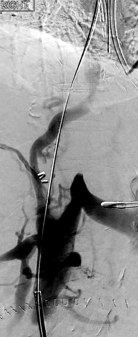 TheRealDoctorOs's tweet photo. In honor of my 2000th follower, time to post a case worthy of 2000 people 😎 Liver/kidney transplant c/b IVC thrombosis and anastamotic stenosis...successfully treated with AngioVac / Cleaner / Z stent (clot video in comments) #irad #DVTfree https://t.co/Ho4UKuTINh