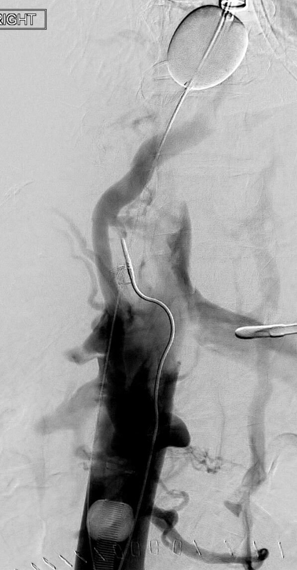 TheRealDoctorOs's tweet photo. In honor of my 2000th follower, time to post a case worthy of 2000 people 😎 Liver/kidney transplant c/b IVC thrombosis and anastamotic stenosis...successfully treated with AngioVac / Cleaner / Z stent (clot video in comments) #irad #DVTfree https://t.co/Ho4UKuTINh