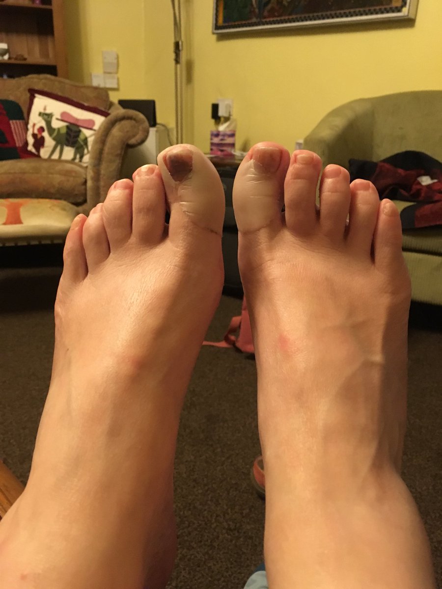 2foolishprod's tweet photo. Over the last 10 days Karen has done 380,000 steps, 158 miles and 2,017 flights of stairs on the South West Coast Path. On Monday she has to fit these feet into thigh length 6” heel boots.
#dedication #remindmeagain #edfringe #MakeYourFringe @SweetVenues https://t.co/vlXVhJgV7e