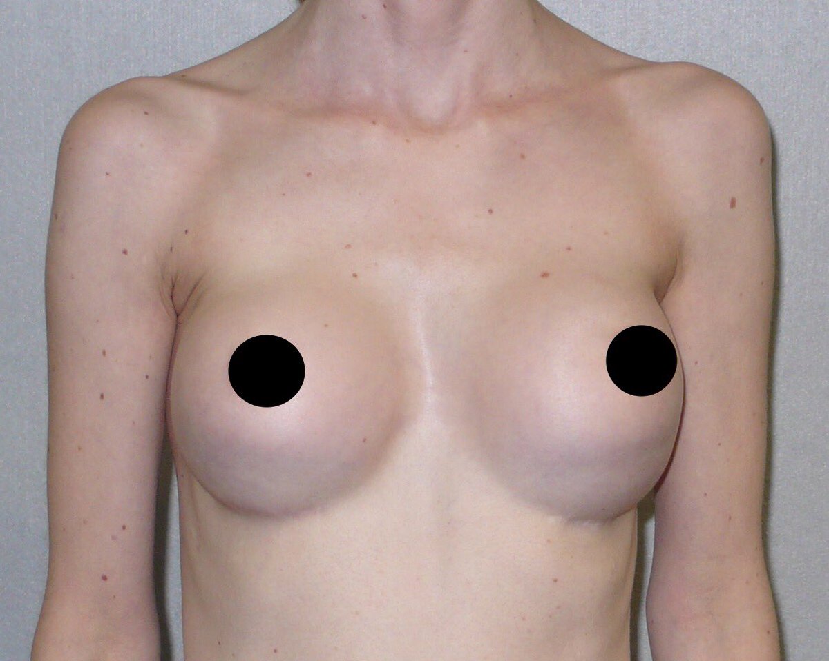 saferimplants's tweet photo. Double bubble - implant sitting below the breast creating deformity. This grade 4 surface failed to incorporate and required removal with precise complete capsulectomy. A failure of implant performance, placement and technique. This patient opted for no implants. #endbotched https://t.co/PH0QItrOjS