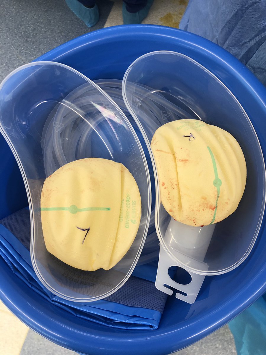 saferimplants's tweet photo. Double bubble - implant sitting below the breast creating deformity. This grade 4 surface failed to incorporate and required removal with precise complete capsulectomy. A failure of implant performance, placement and technique. This patient opted for no implants. #endbotched https://t.co/PH0QItrOjS