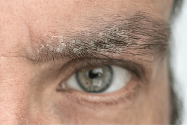 Health_tipspro's tweet image. How To Get Rid Of Eyebrow Dandruff healthphreaks.com/2019/08/15/eye…